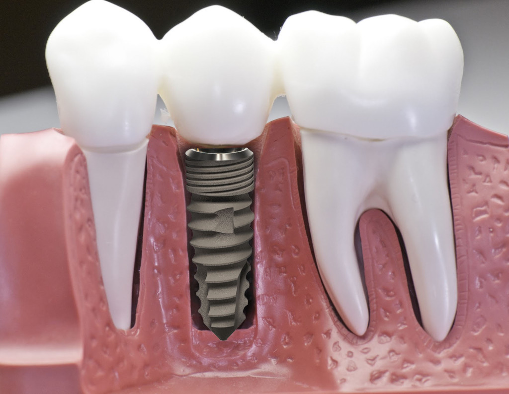 Trồng răng implant dentium là gì
