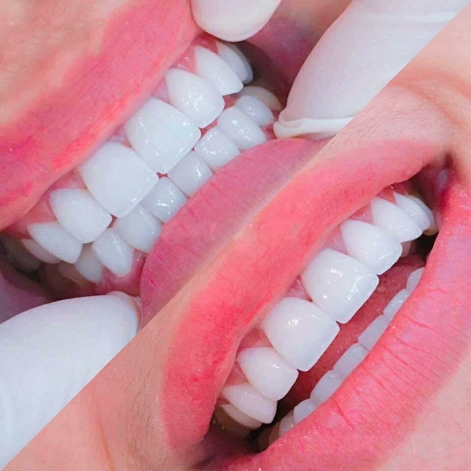 các loại răng sứ