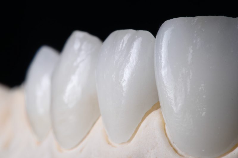 ưu điểm khi bọc răng sứ Ceramill