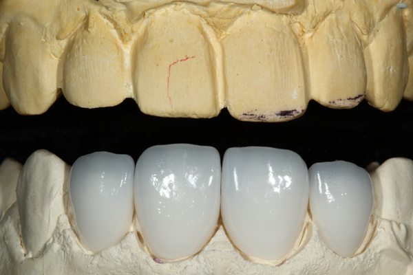 Ưu điểm của răng sứ Cercon