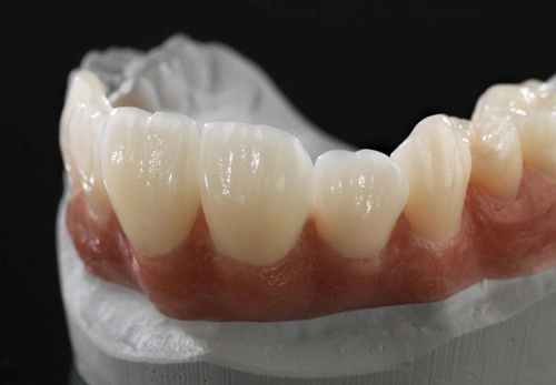 ưu điểm khi bọc răng sứ Ceramill 