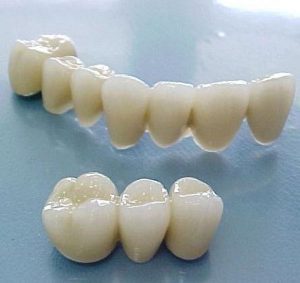 Các quy trình bọc răng sứ Cercon