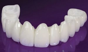 So sánh răng sứ Cercon và Cercon HT