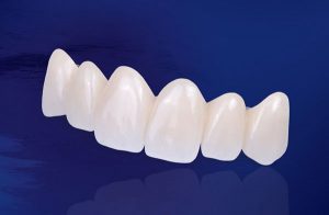 Răng toàn sứ DDBio là gì?