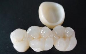 Các ưu điểm, nhược điểm của răng sứ DDBIO