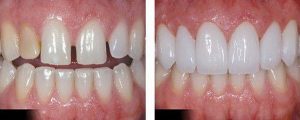 So sánh giữa răng sứ Emax và Cercon