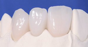Các loại răng sứ Emax hiện nay?