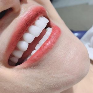Địa chỉ bọc răng sứ HT Smile chất lượng tại tpHCM