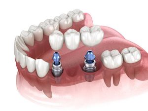 Nên trồng răng sứ hay implant?