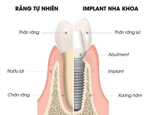 Ưu điểm và nhược điểm của cấy ghép răng Implant