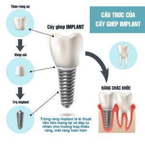 Răng sứ Implant giá bao nhiêu?