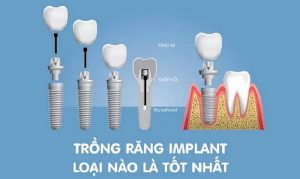 Trồng răng sứ Implant bằng loại nào tốt, bền đẹp?