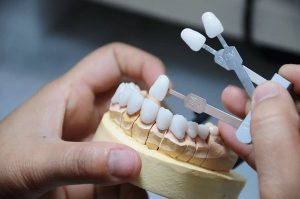 Quy trình bọc răng sứ Lava Plus