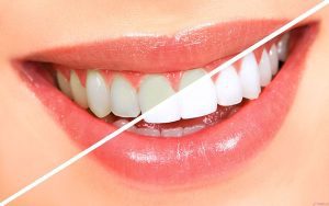 Các lợi ích khi làm răng sứ mỹ phẩm