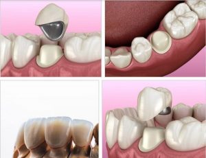 Các dạng răng sứ titan có bao nhiêu phân loại?