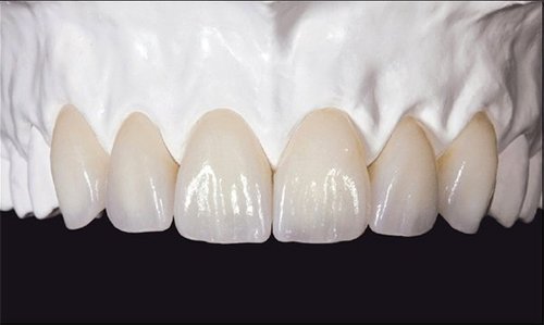 răng sứ zirconia có giá bao nhiêu