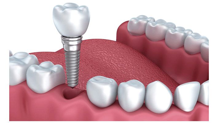 Trồng răng implant là gì