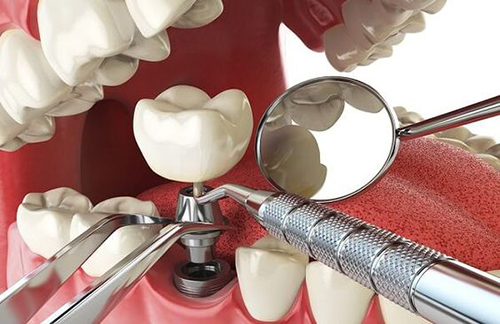 Trồng răng implant có đau không