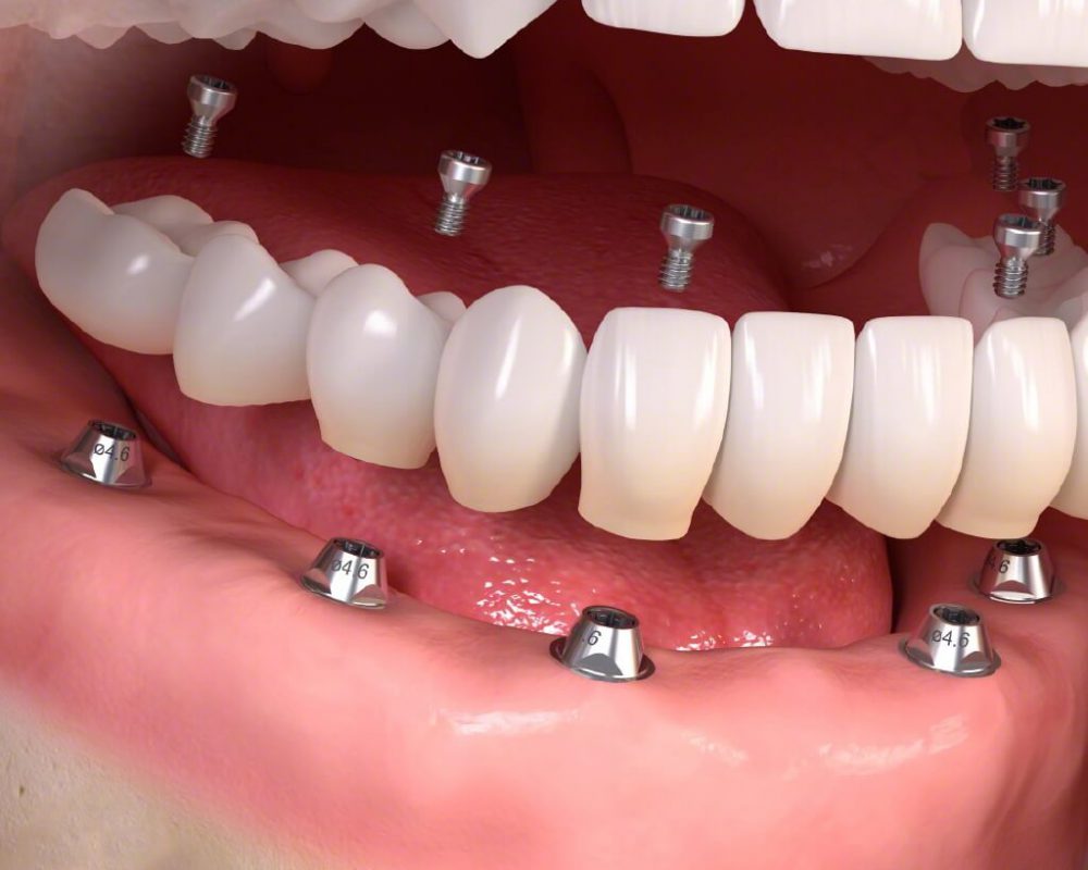 Trồng răng Implant ở đâu