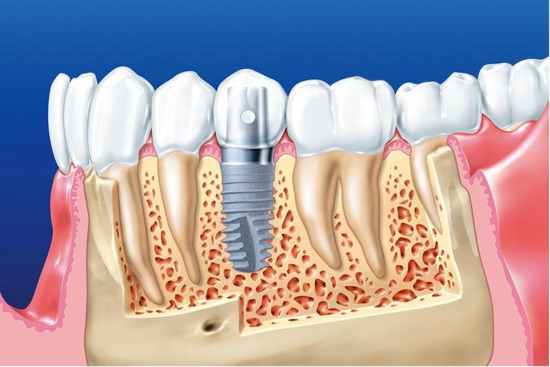 Trồng răng implant có đau không