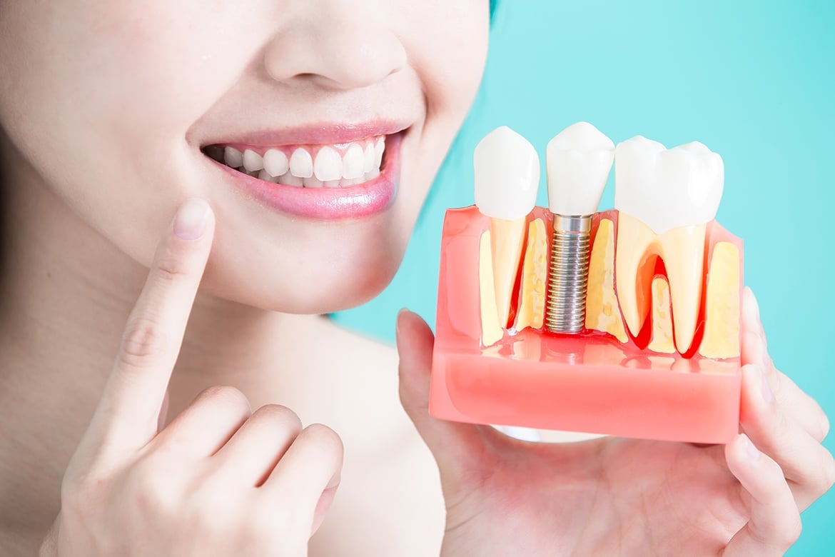 Ưu điểm của trồng răng implant