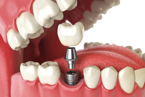 Răng cấm vỡ mẻ phải khắc phục như thế nào