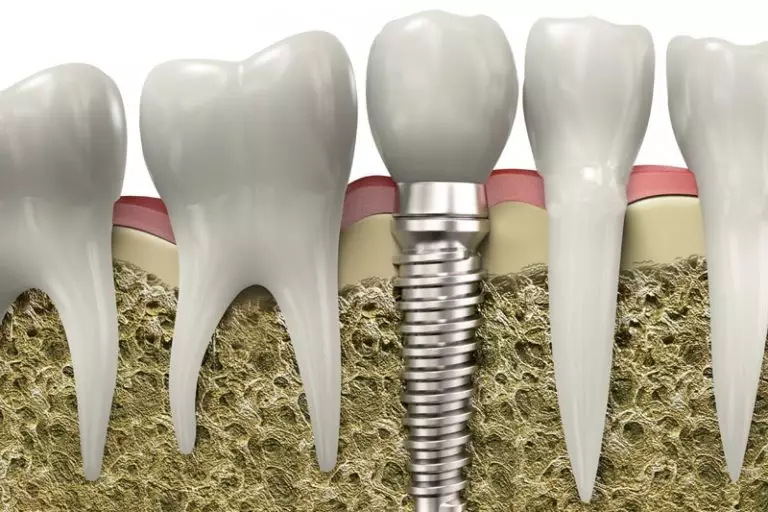 Trồng răng implant dentium là gì