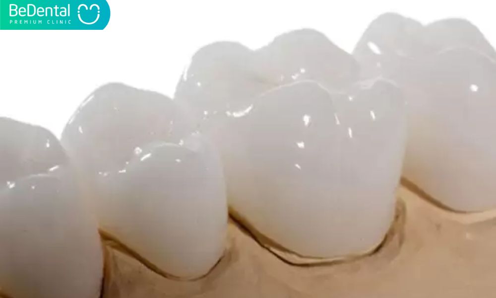 Khi nào nên sử dụng răng sứ Emax 