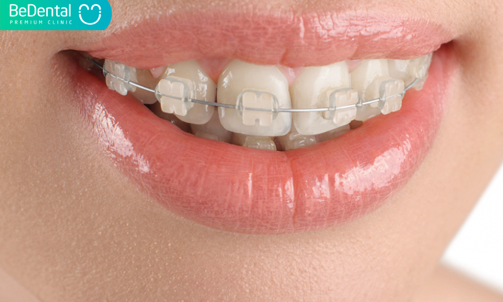 Niềng răng trong suốt có lâu hơn niềng răng truyền thống?
