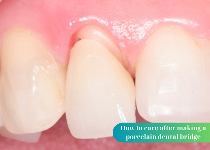 Are porcelain dental bridges good?