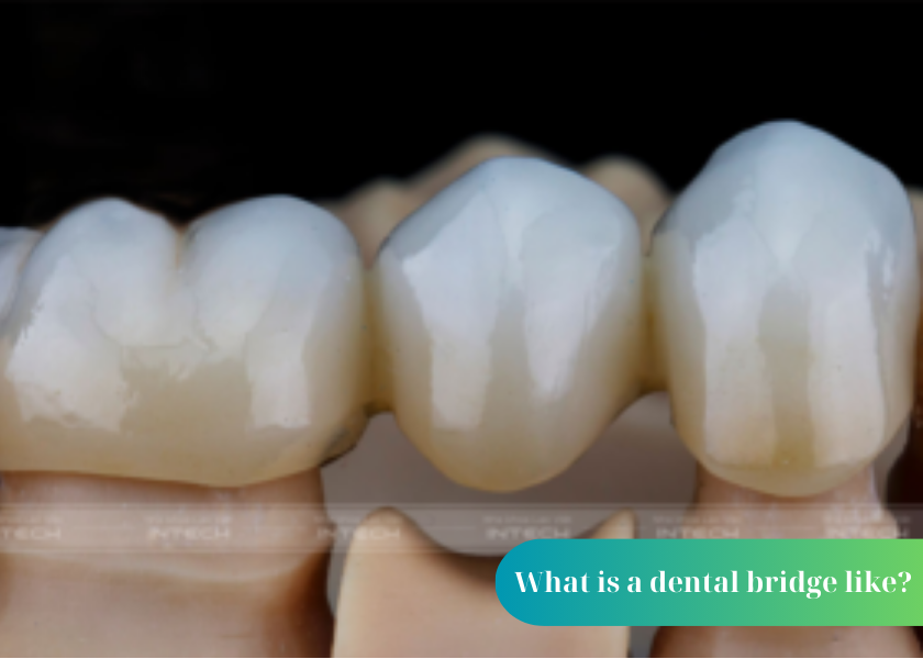 Why does porcelain dental bridge not prevent bone loss? Does a dental bridge get stuck? Complications when making dental bridges