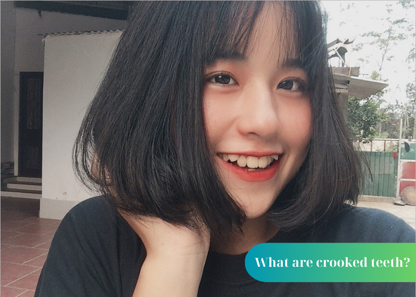 What are crooked teeth?