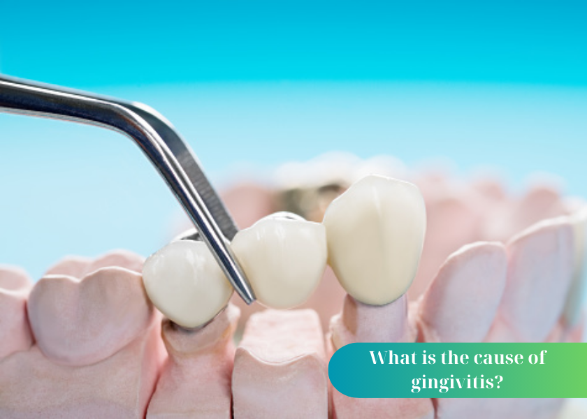 What is the cause of gingivitis