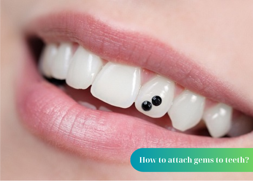 How to attach gems to teeth?