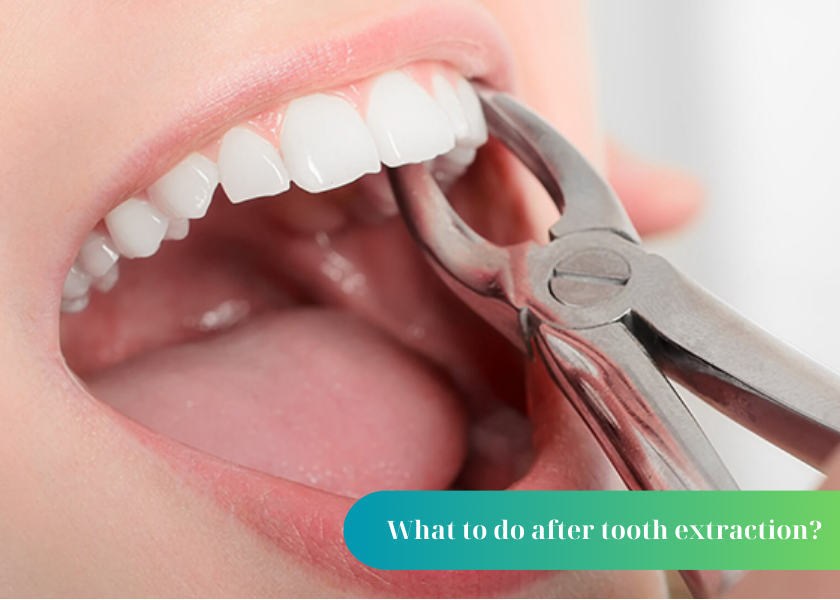 what to do after tooth extraction?