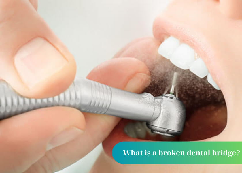 5 Causes of a broken dental bridge 