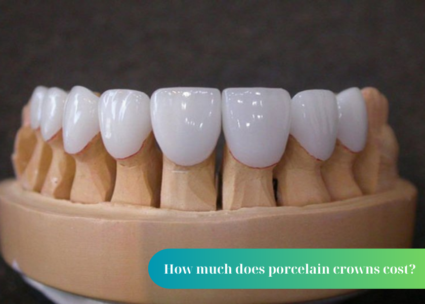 How much does porcelain crowns cost? When should porcelain crowns be placed on teeth? Benefits of having porcelain crowns on teeth