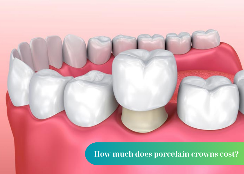 How much does porcelain crowns cost? When should porcelain crowns be placed on teeth? Benefits of having porcelain crowns on teeth