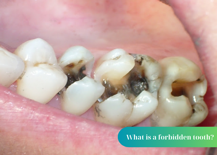 How should a 6-year-old child's forbidden tooth be treated for decay?