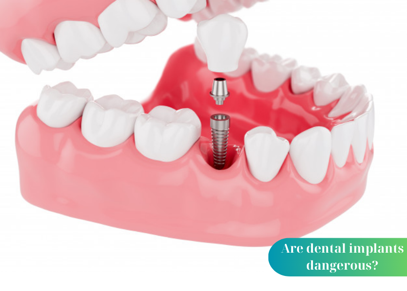 Are dental implants dangerous?