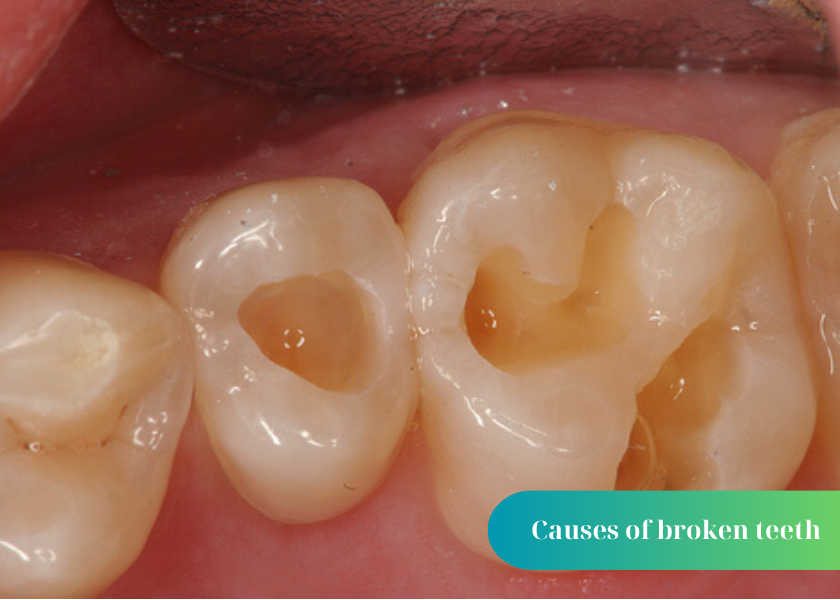 How to fix a broken tooth?