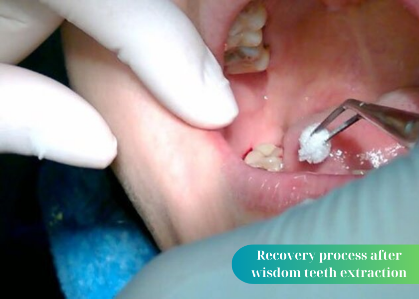 Wisdom teeth extraction cannot stop bleeding