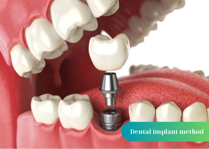 Can you get braces after dental implants?