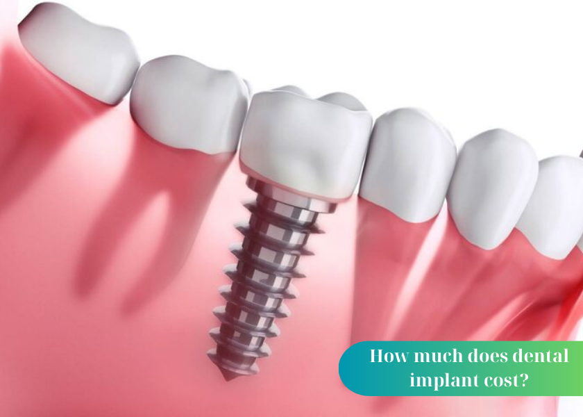 Should I get dental implants or dental dentures?
