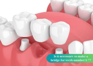 Is it necessary to make a bridge for teeth number 6-7?