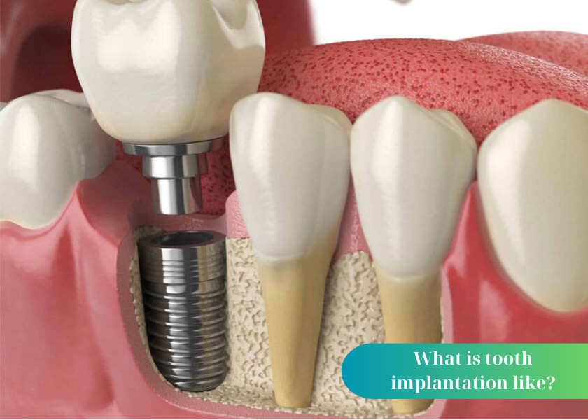 How long does dental implant take?