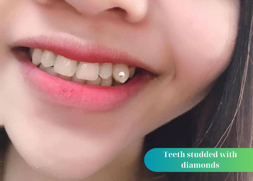 Teeth studded with diamonds