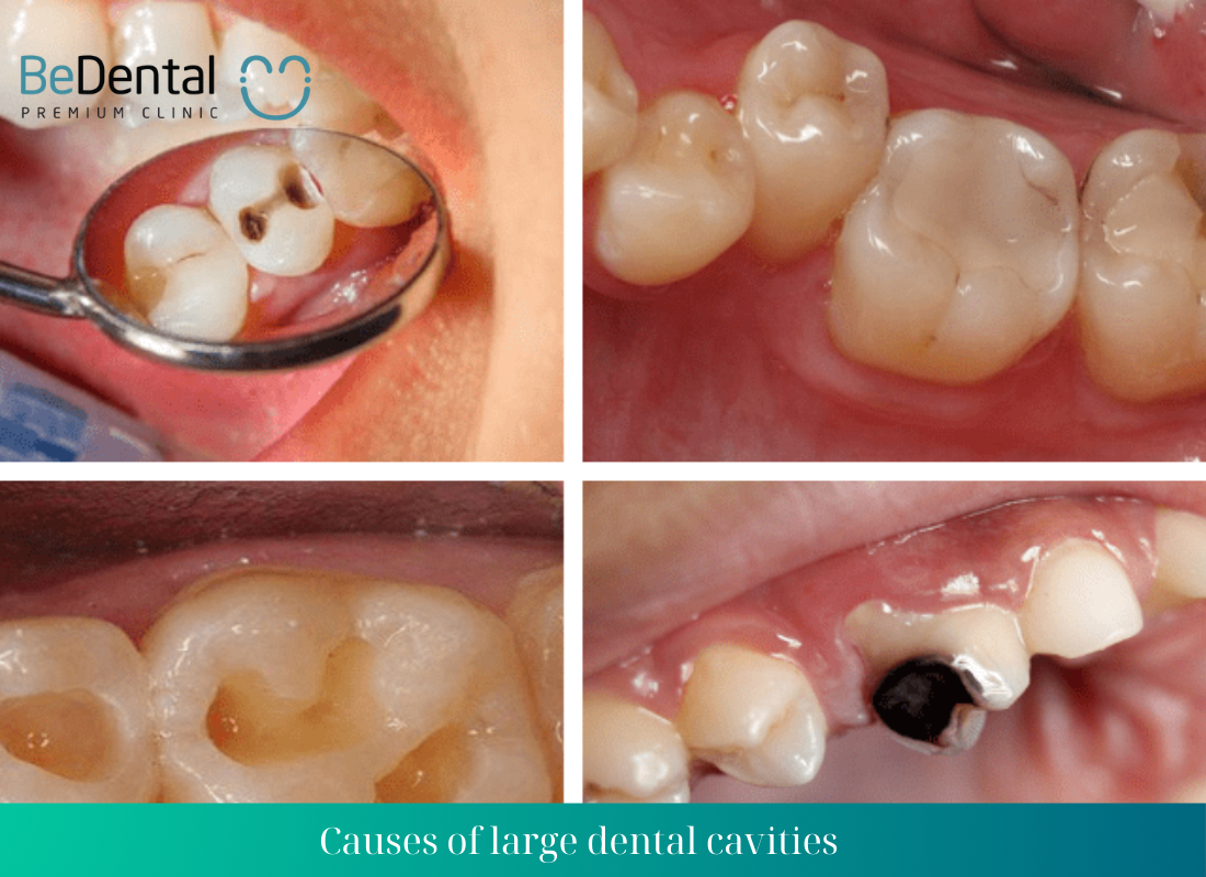 Large dental cavities 2