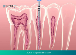 Lấy tủy răng là gì? TRIỆU CHỨNG SAU KHI LẤY TỦY RĂNG