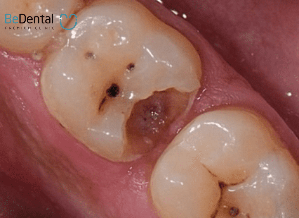 Mẻ răng hàm là gì ?